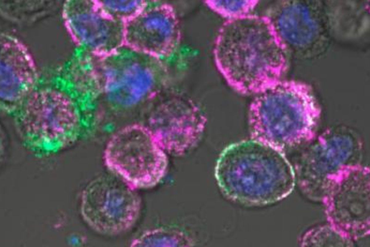 Células tumorales infectadas por virus oncol�ticos; en púrpura, expresión CD19 en la superficie. Foto: DM. 